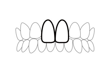 出っ歯（上顎前突）