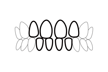 すきっ歯(空隙歯列弓)